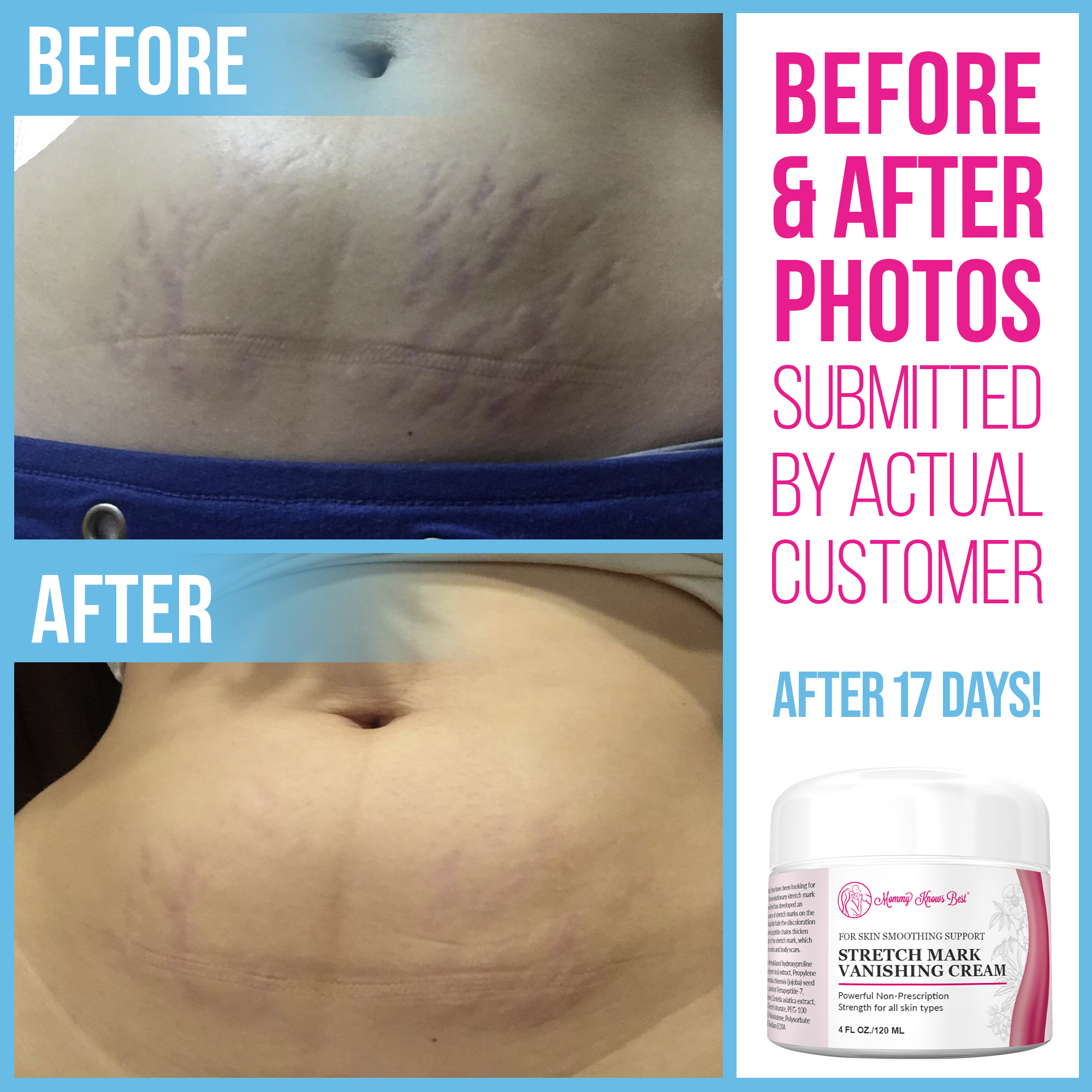 Stretch Mark Vanishing Cream - 4oz